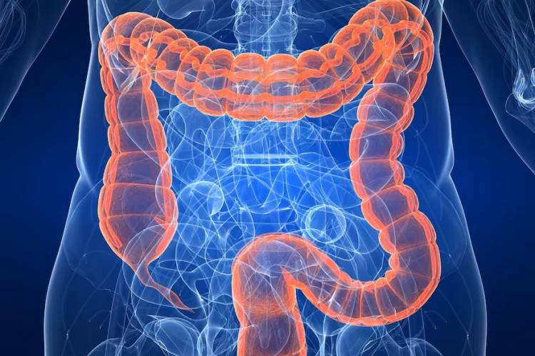 El cáncer de colon crece entre jóvenes en el mundo. Cuál es la situación en la Argentina y qué recomiendan los expertos