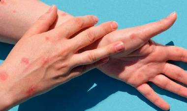 Confirman un caso de viruela del mono en San Isidro: no tenía antecedentes de viaje