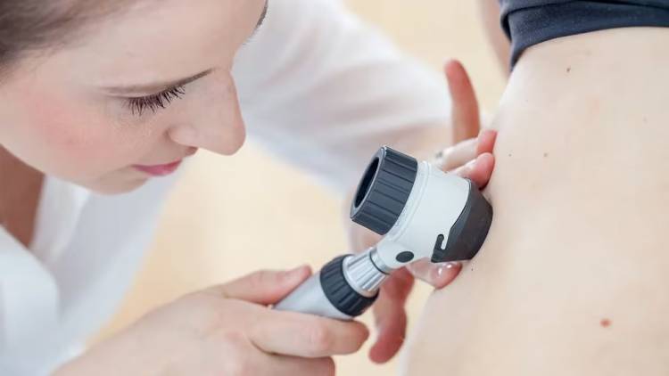 Cáncer de piel: desarrollan la primera vacuna de ARNm personalizada para tratar pacientes con melanoma